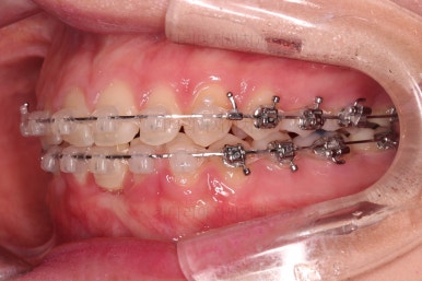 부산교정치과추천