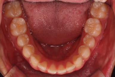 부산연산동치아교정
