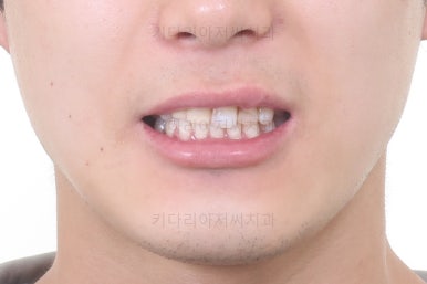 연산동치아교정