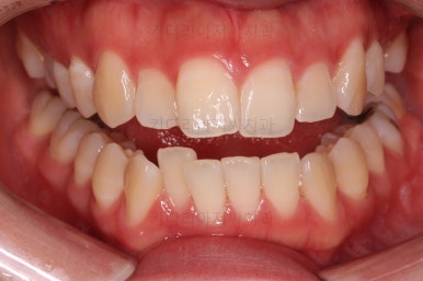 부산비대칭교정