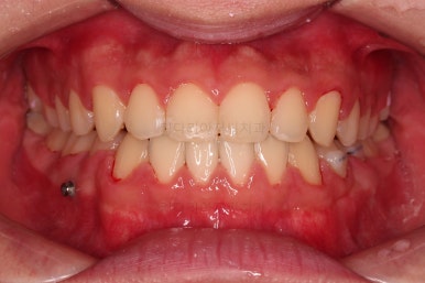 부산주걱턱교정