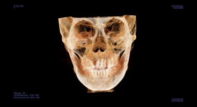 부산구순구개열