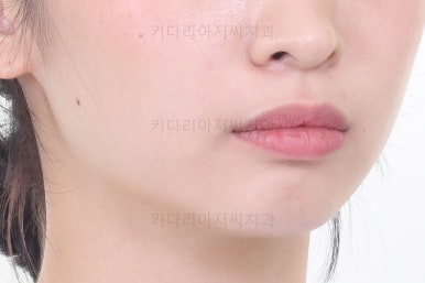 부산돌출입교정