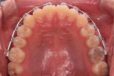 부산치아교정잘하는곳