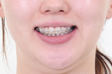 부산비대칭교정