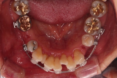 동래임플란트교정