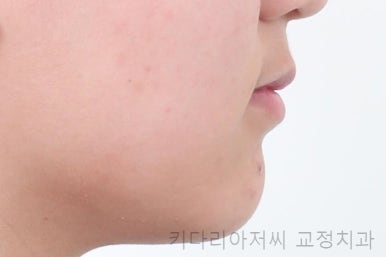 연산동치아교정