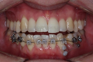 부산비수술교정