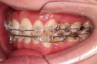 부산돌출입교정