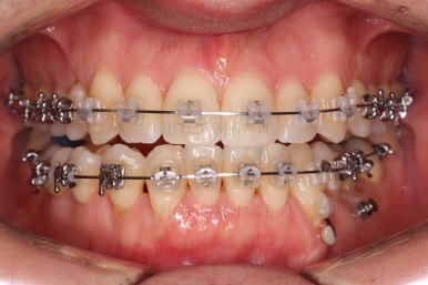 부산비수술교정