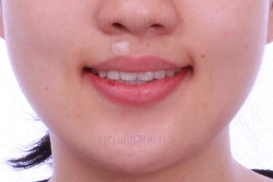 부산비발치교정