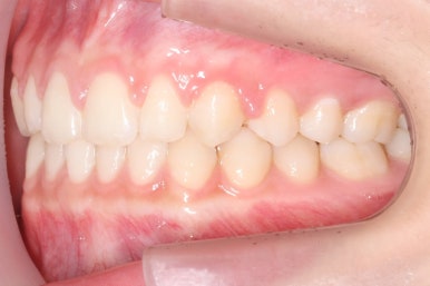 부산매복치아교정