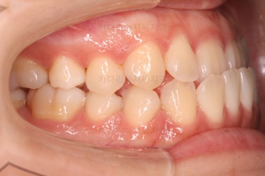 부산치아교정추천