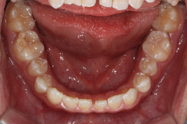 부산왜소치교정