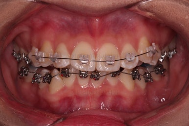 연산동치아교정치과