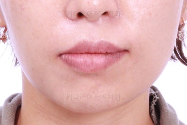 부산연산동교정치과