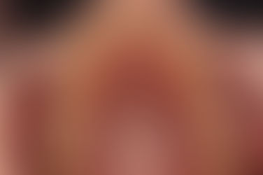 부산덧니교정