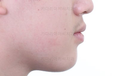 부산연산동사랑니발치