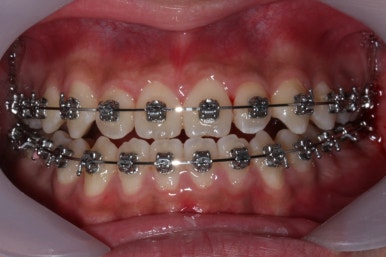 부산주걱턱교정