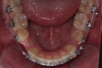 부산구순구개열