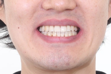 부산비수술교정