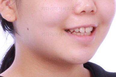 부산앞니벌어짐교정