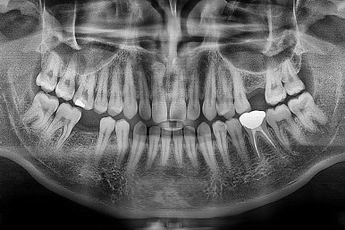 연산동임플란트
