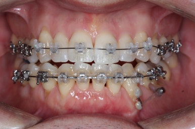 부산비수술교정