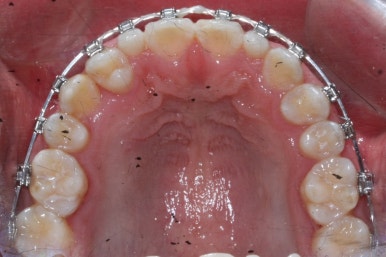 부산왜소치교정