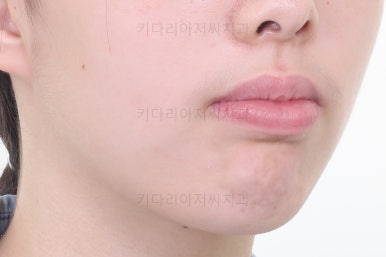 부산투명교정