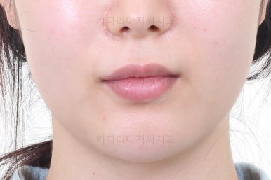 부산부분치아교정