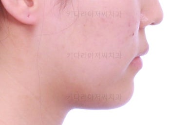 부산비발치교정