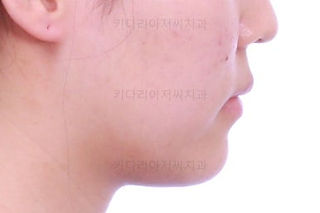 부산비발치교정