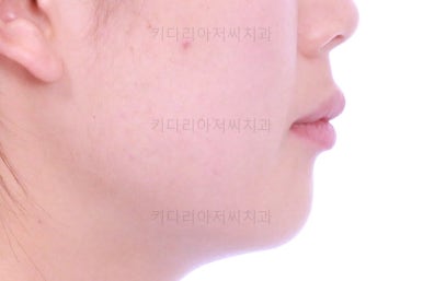 부산앞니부분교정