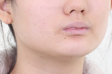 연산동치아교정