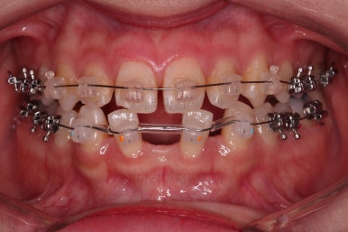 부산교정치과추천
