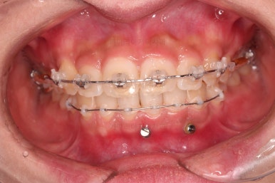 부산앞니부분교정