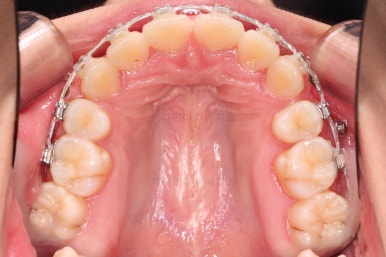 부산클리피씨교정