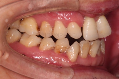 부산구순구개열교정