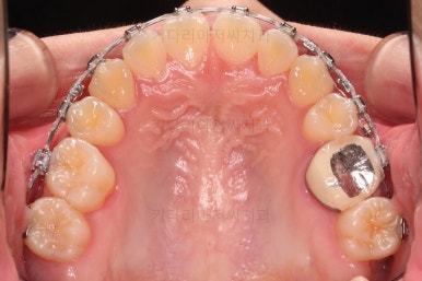 동래구치아교정