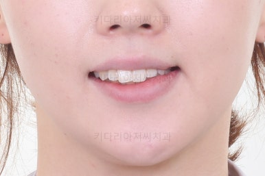 부산비대칭교정