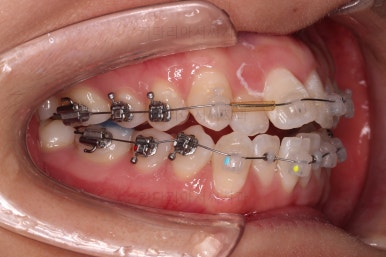 부산교정잘하는치과