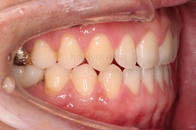 연산동임플란트