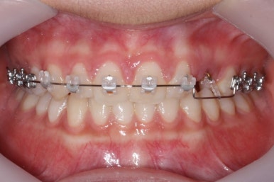 부산매복치아교정