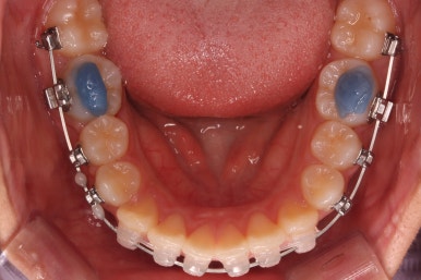부산치아교정잘하는곳