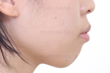 부산클리피씨교정