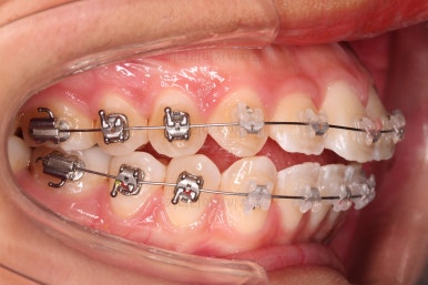 부산연산역치아교정