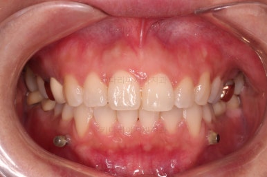 부산부분치아교정