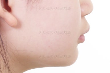 부산어린이치아교정