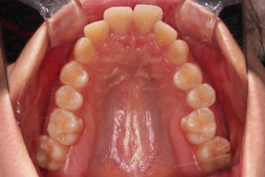 부산클리피씨교정